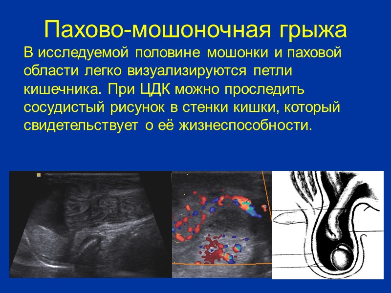 Глистная инвазия яичка (дирофиляриоз оболочек яичка)